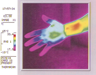 Hand thermography after 16 minutes with Uni Wrap