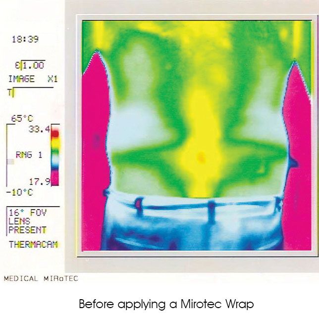 Mirotec Foot & Ankle Wrap